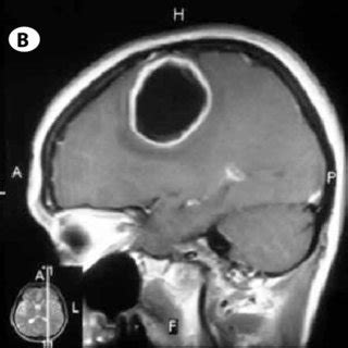 Preoperative T1 Weighted Contrast Enhanced Magnetic Resonance Images