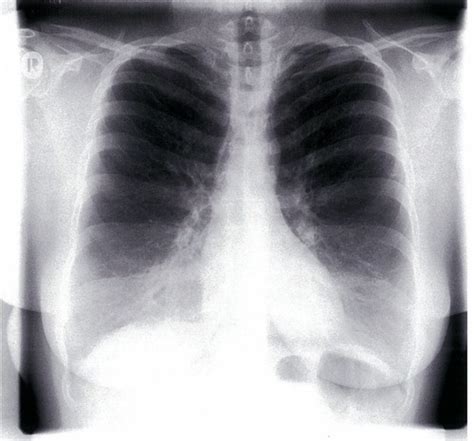 Röntgen Thorax Anatomie Flashcards Quizlet