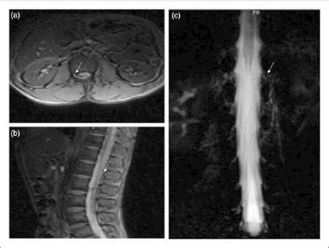 Sagittal Magnetic Resonance Myelography Imaging Of The Entire Spinal Download Scientific