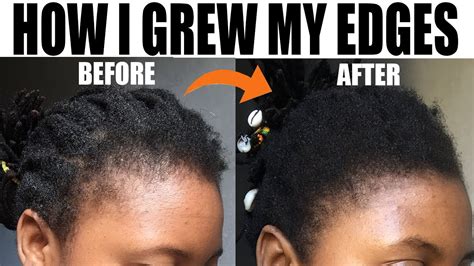 Regrow Your Edges And Baldspots Youtube