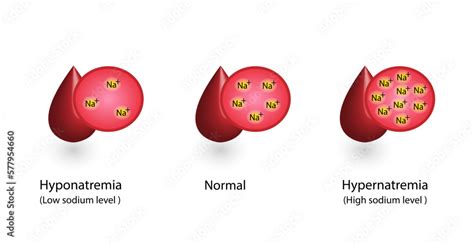 Stockvektorbilden Hypernatremia High Plasma Sodium Level And