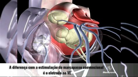 Entenda Como Funciona O CDI Cardiodesfibrilador Implantavel E