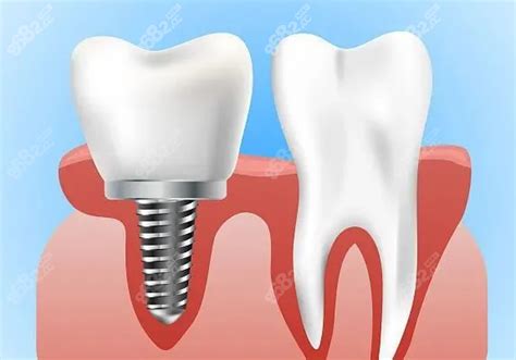 种植牙得满足即拔即种的条件才可以当天拔牙当天种牙牙齿对比照片 8682整形网