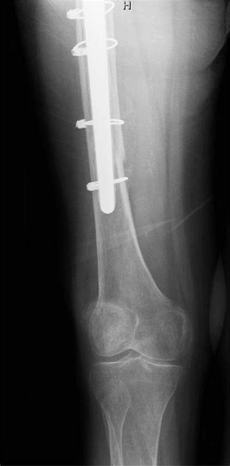 Distal details of revision arthroplasty | Download Scientific Diagram