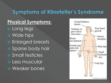 Klinefelter Syndrome Pictures Symptoms Causes Treatment | Sexiz Pix