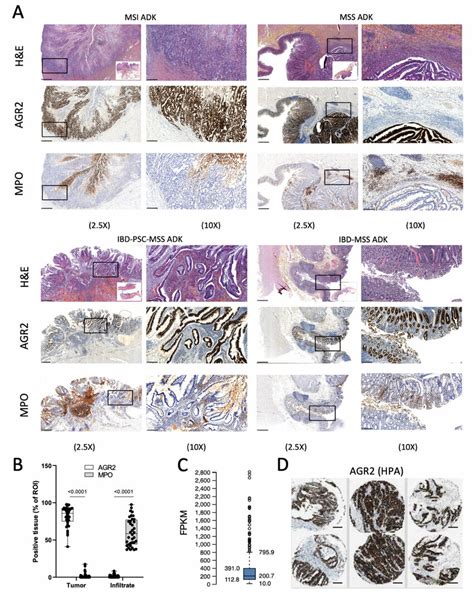 Colonic Tumourous Epithelial Cells Are The Predominant Cell Type