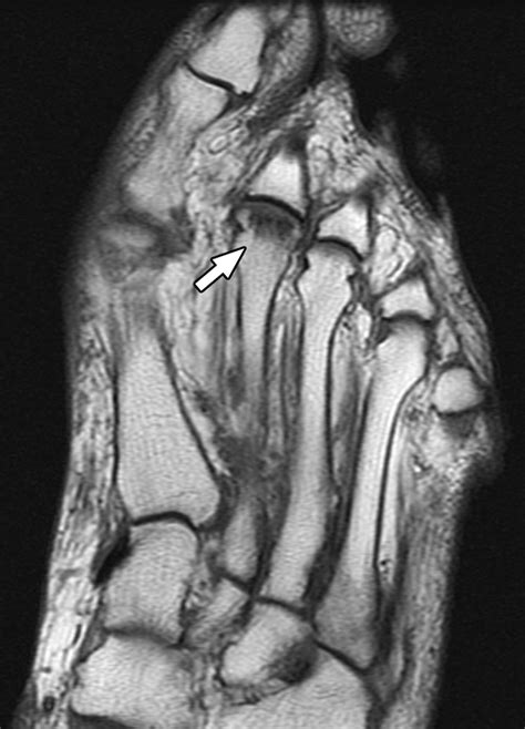 Metatarsal Stress Fracture Mri