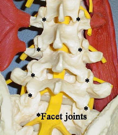 Facet Arthritis - Drwolgin
