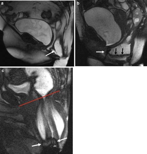 Rectal Intussusception Mid Sagittal T2 Weighted Images Demonstrate The