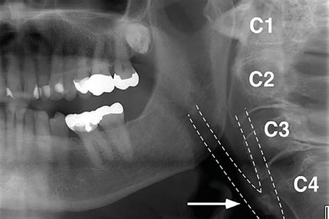 Panoramic And 3 Dimensional Images Can They Detect Potential Carotid