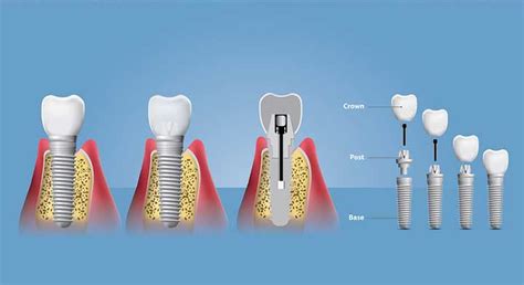 An Overview Of Dental Implants East Side Dental