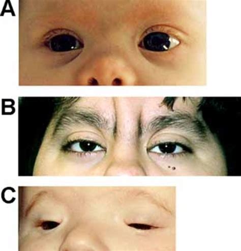 3p deletion syndrome: MedlinePlus Genetics