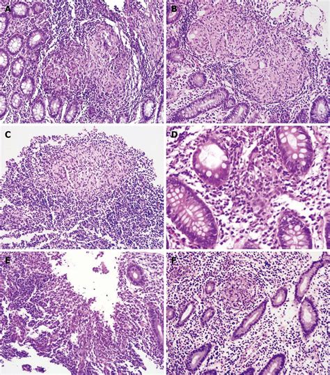 Tuberculosis Histology - Duke Pathology - Pulmonary System - War ...