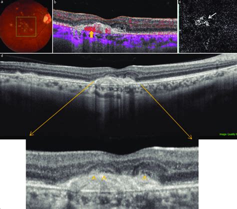 Ss Oct In A Patient With Multifocal Choroiditis A Shows Multiple