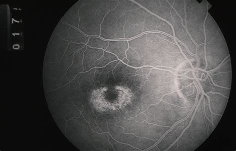 Plaquenil Toxicity Retina Image Bank