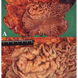 A Gross Appearance Of The Entire Resected Stomach Greater Omentum