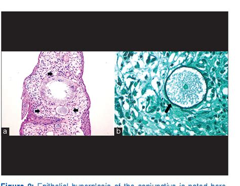 Figure From Rhinosporidiosis Of The Tarsal Conjunctiva Semantic Scholar