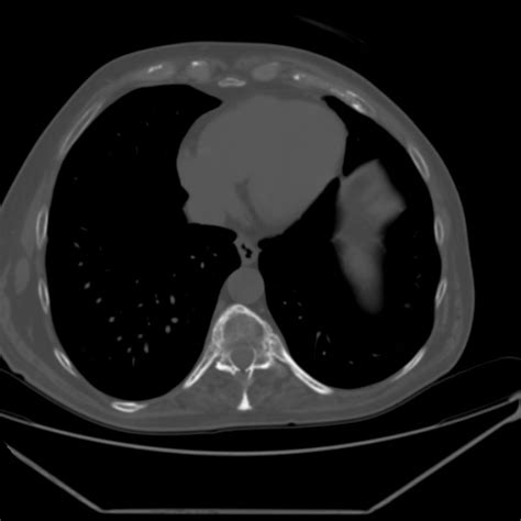 Bamboo spine (Radiopaedia 61848-69879 Axial bone window) - NC Commons