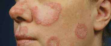 Systemic Lupus Erythematosus Swc Healthcare