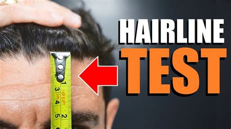 How To Tell If You Have A Receding Hairline