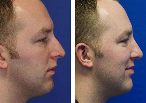 Long Over Projected Nose Rhinoplasty In Seattle Rhinoplasty Surgeon