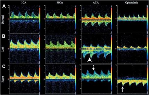 Transcranial Doppler Ultrasound