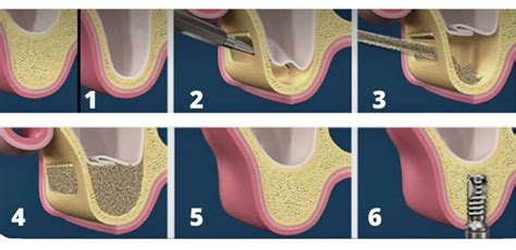 Precio Del Injerto De Hueso Dental Clinica Dental Palomero