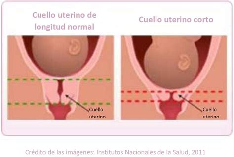 Insuficiencia Cervical Y El Cuello Uterino Corto Nacersano 39440 The