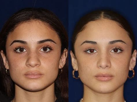 Ethnic Rhinoplasty in Beverly Hills | Dr. Robert Kotler | Ethnic rhinoplasty, Rhinoplasty ...