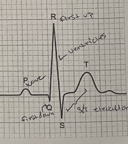 Ekg Rhythms Flashcards Quizlet