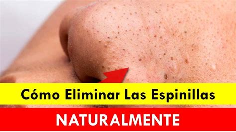 C Mo Eliminar Las Espinillas Y Los Puntos Negros Naturalmente Con