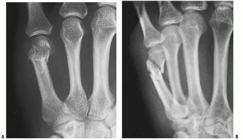 Ultrasound-Guided Ulnar Nerve Block at the Wrist | Anesthesia Key