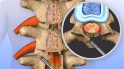 Lumbar Laminectomy Fusion Instrumented Animation Ph