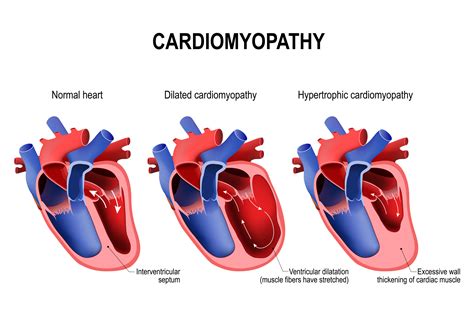 Enlarged Heart Compared To Normal Heart