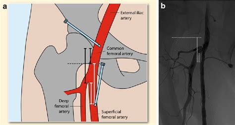 Ultrasound-guided antegrade femoral access: comparison between the common femoral artery and the ...