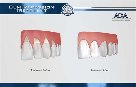 Gum Recession — Viva Concepts