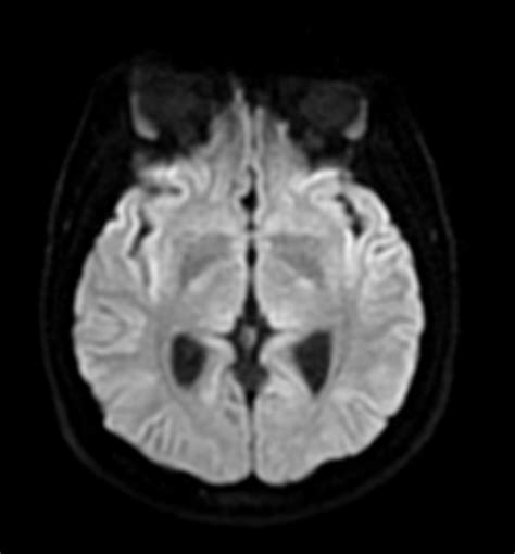 Closed Lip Schizencephaly With A Focal Cortical Dysplasia Image