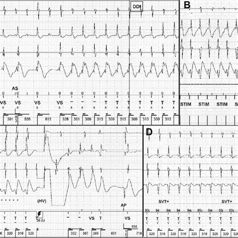 A Intracardiac Electrogram EGM Demonstrating Initial Tachycardia