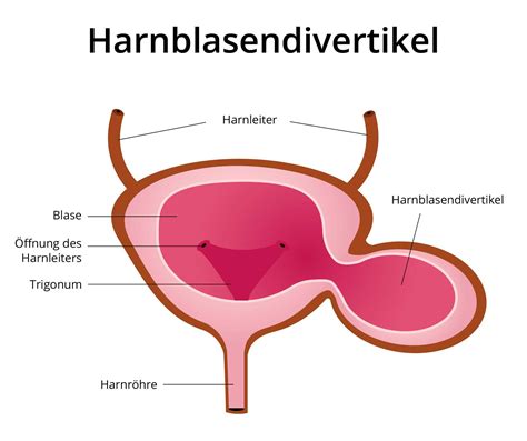 Harnblasendivertikel Ursachen Symptome Behandlung