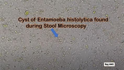 Entamoeba Histolytica Cyst In Stool