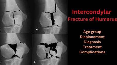 Intercondylar Fracture Of Humerus Humerus Intercondylar Fracture Treatment And Complications