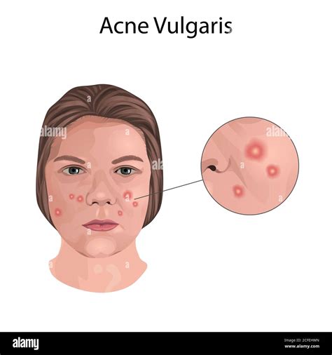 Mild Acne Vulgaris