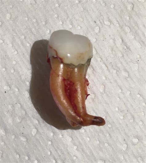 wwwbestogdendentistcom blog   pulling teeth