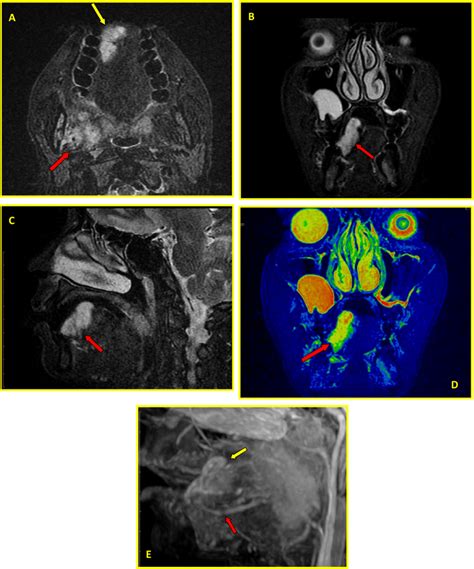 A E Arterio Venous Vascular Malformation Of The Tongue 11 Years Old