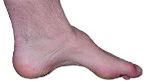 how to fix high arch foot