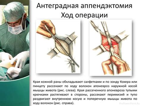 Аппендектомия. Способы аппендэктомии - презентация онлайн