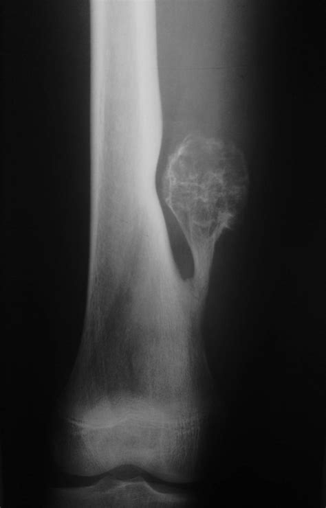 Osteochondroma Image Radiopaedia Org