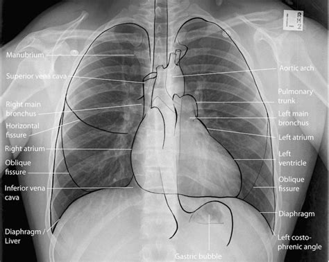 Approach To The Chest X Ray CXR Undergraduate Diagnostic Imaging