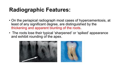 Hypercementosis Ppt