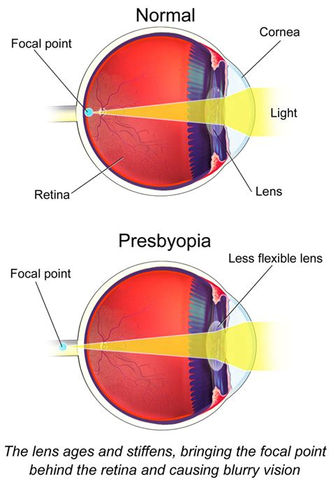 Presbyopia Central Florida Eye Center Pa